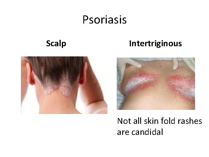 Psoriasis Scalp Intertriginous Not all skin fold rashes are candidal 