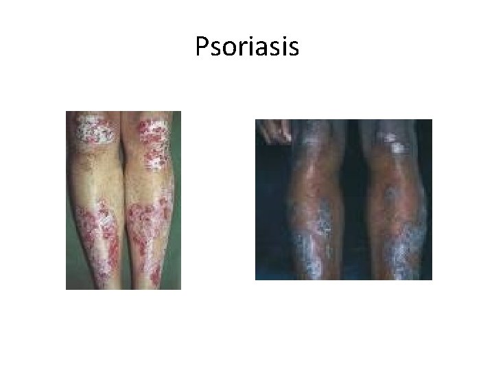 Psoriasis 