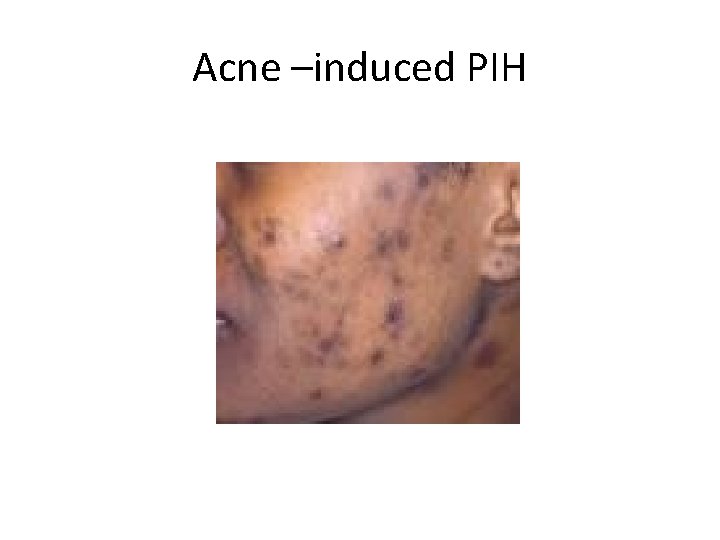 Acne –induced PIH 