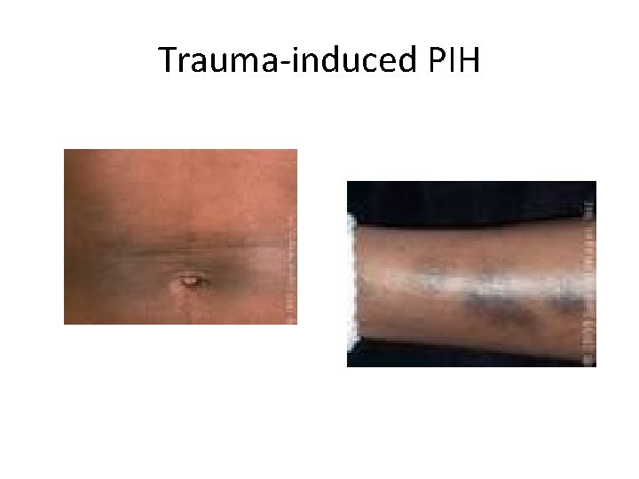 Trauma-induced PIH 