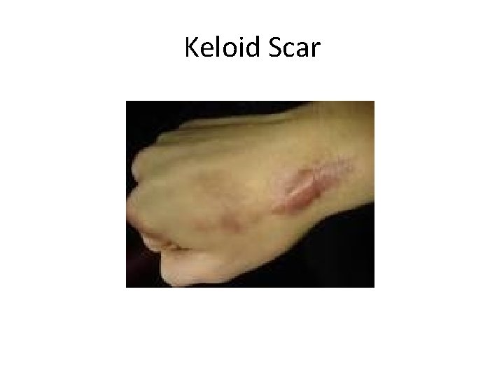 Keloid Scar 