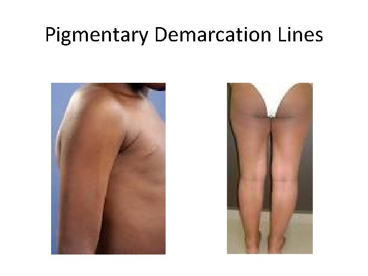 Pigmentary Demarcation Lines 