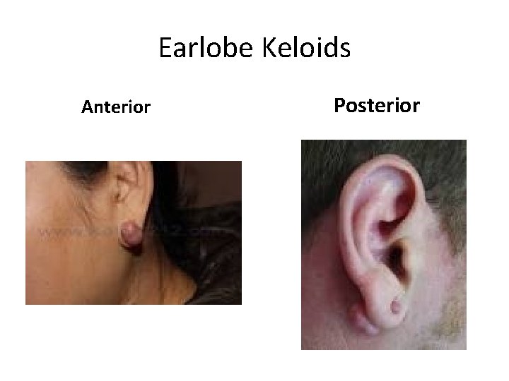 Earlobe Keloids Anterior Posterior 