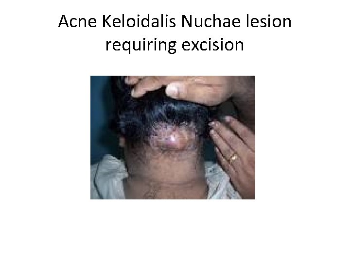 Acne Keloidalis Nuchae lesion requiring excision 