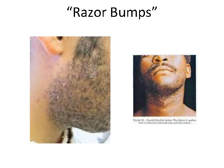 “Razor Bumps” 