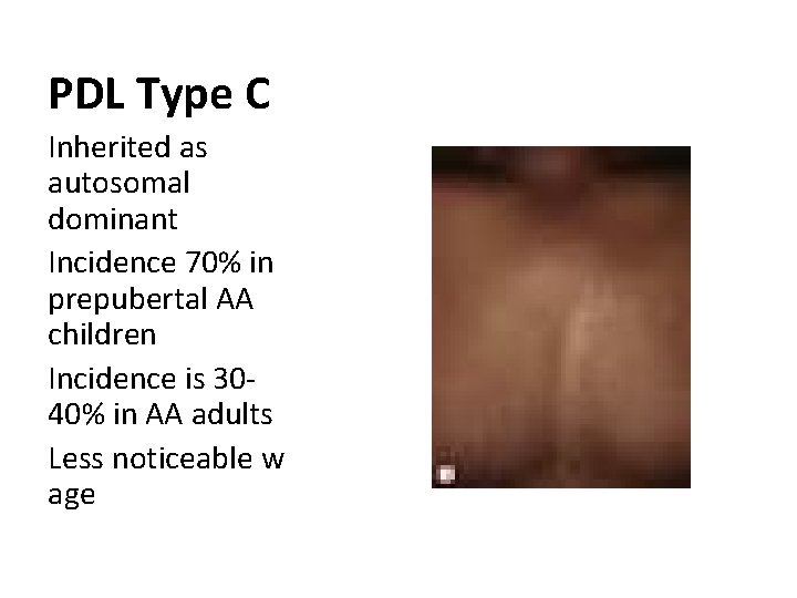 PDL Type C Inherited as autosomal dominant Incidence 70% in prepubertal AA children Incidence