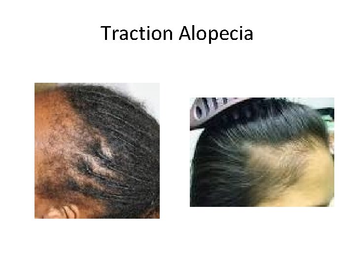 Traction Alopecia 
