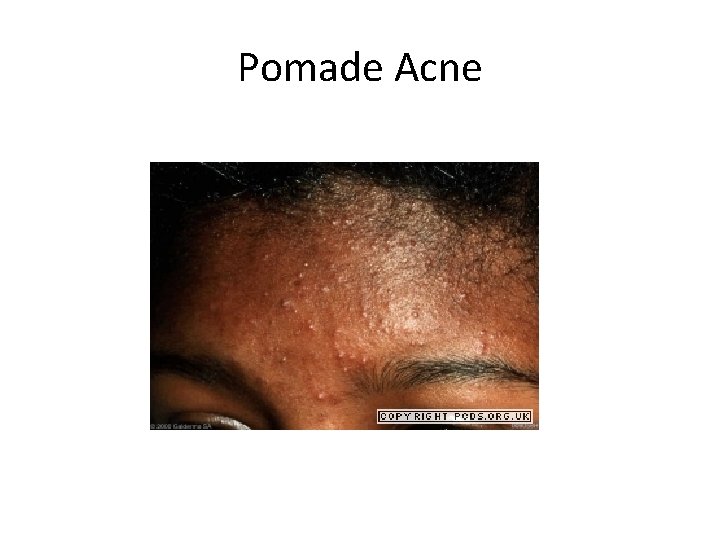 Pomade Acne 
