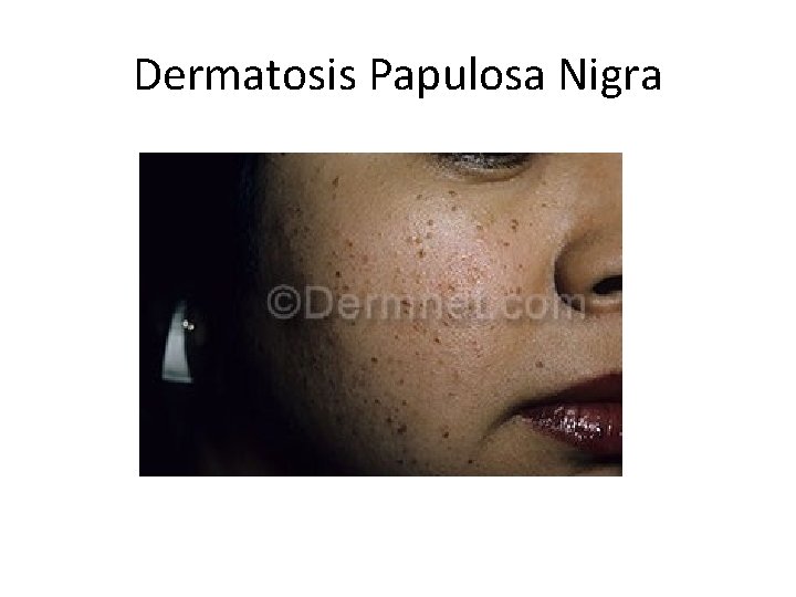 Dermatosis Papulosa Nigra 