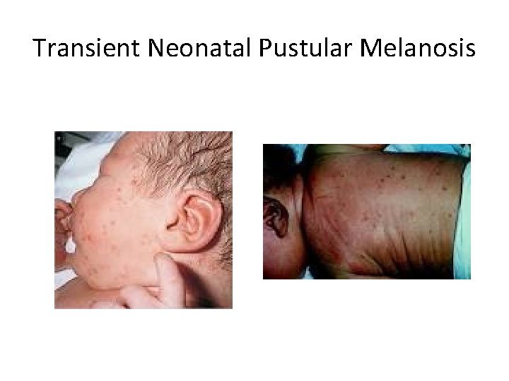 Transient Neonatal Pustular Melanosis 