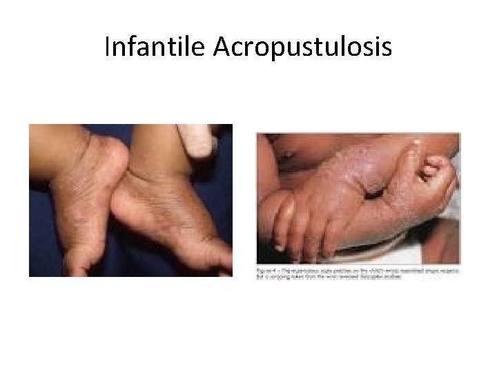 Infantile Acropustulosis 