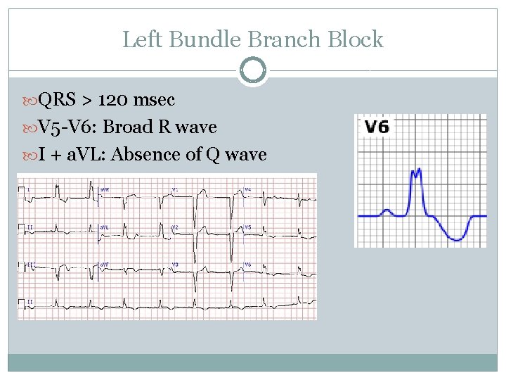 Left Bundle Branch Block QRS > 120 msec V 5 -V 6: Broad R