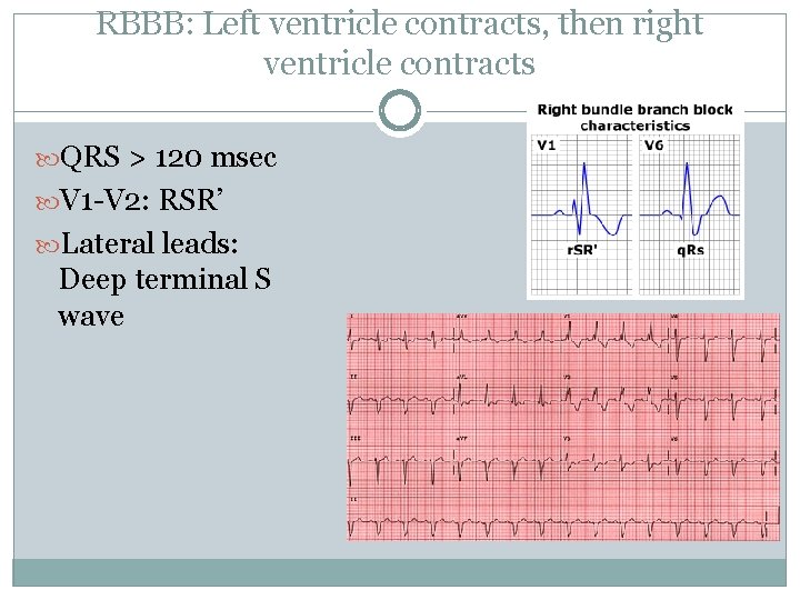 RBBB: Left ventricle contracts, then right ventricle contracts QRS > 120 msec V 1