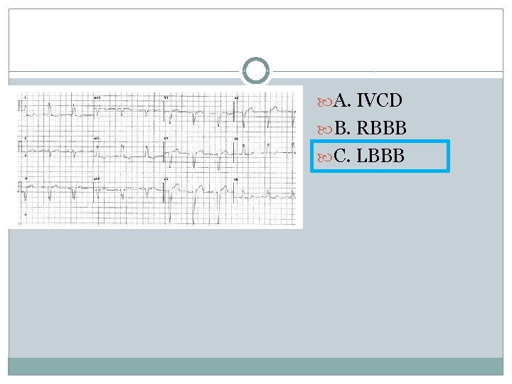  A. IVCD B. RBBB C. LBBB 