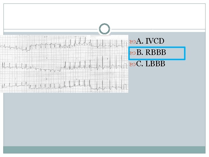  A. IVCD B. RBBB C. LBBB 
