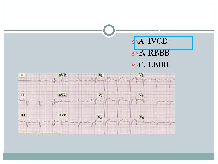  A. IVCD B. RBBB C. LBBB 