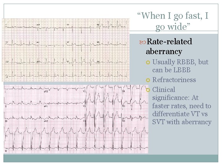 “When I go fast, I go wide” Rate-related aberrancy Usually RBBB, but can be
