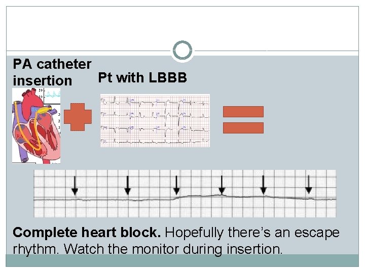 PA catheter Pt with LBBB insertion Complete heart block. Hopefully there’s an escape rhythm.