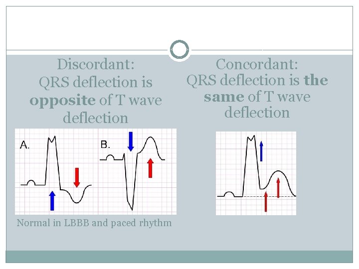 Discordant: QRS deflection is opposite of T wave deflection Normal in LBBB and paced