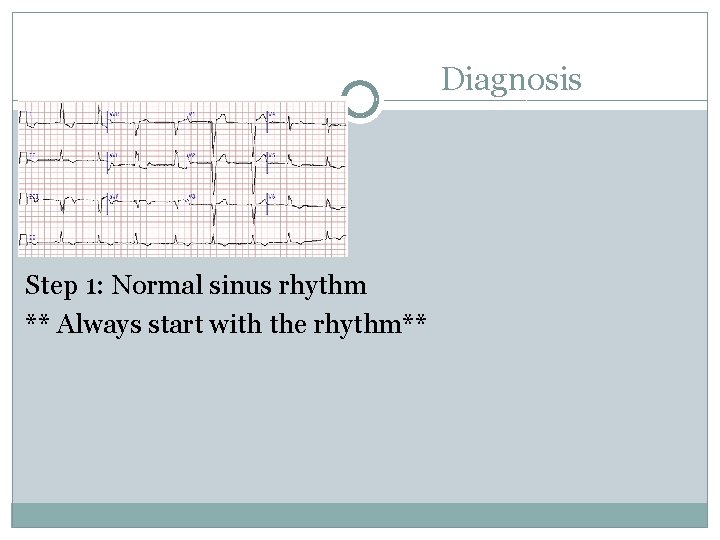 Diagnosis Step 1: Normal sinus rhythm ** Always start with the rhythm** 