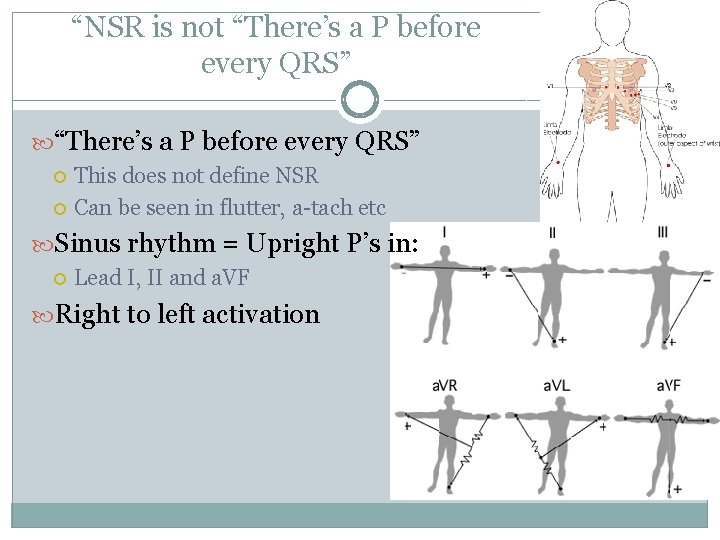 “NSR is not “There’s a P before every QRS” This does not define NSR