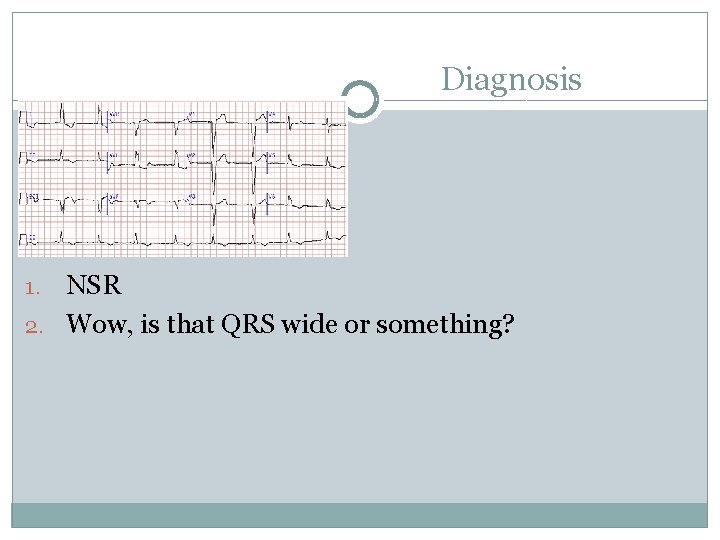 Diagnosis NSR 2. Wow, is that QRS wide or something? 1. 