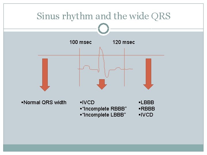 Sinus rhythm and the wide QRS 100 msec §Normal QRS width 120 msec §IVCD