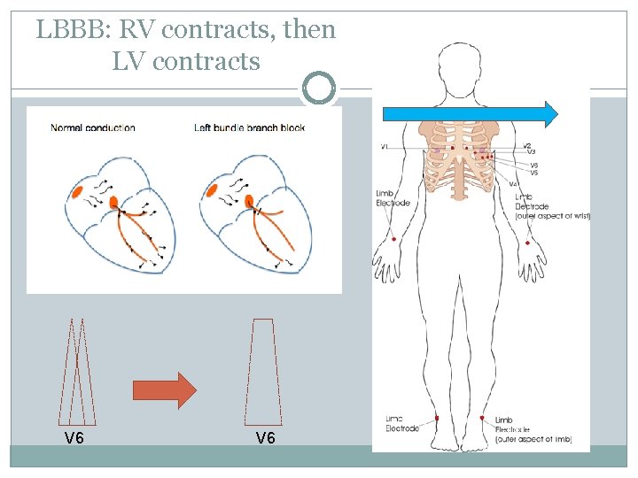 LBBB: RV contracts, then LV contracts V 6 