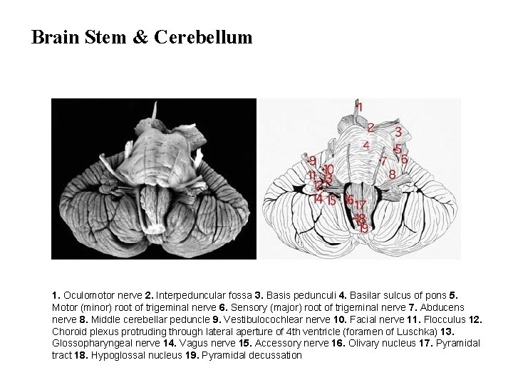 Brain Stem & Cerebellum 1. Oculomotor nerve 2. Interpeduncular fossa 3. Basis pedunculi 4.