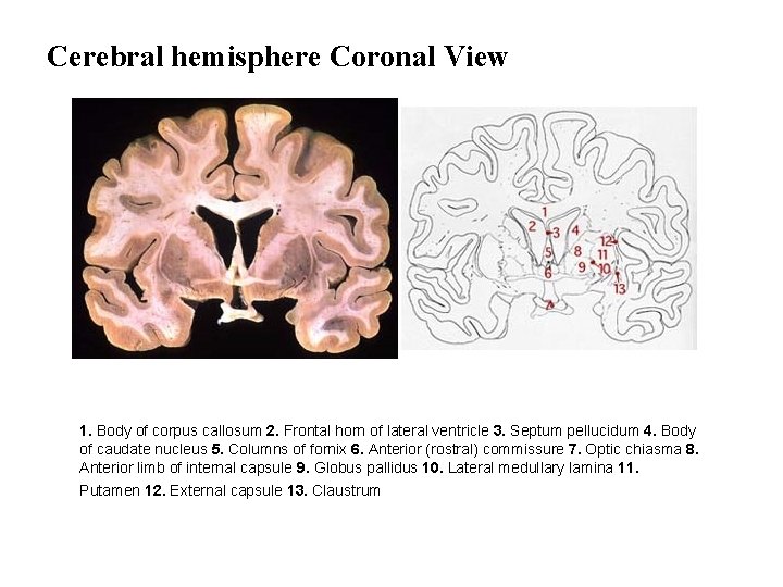 Cerebral hemisphere Coronal View 1. Body of corpus callosum 2. Frontal horn of lateral