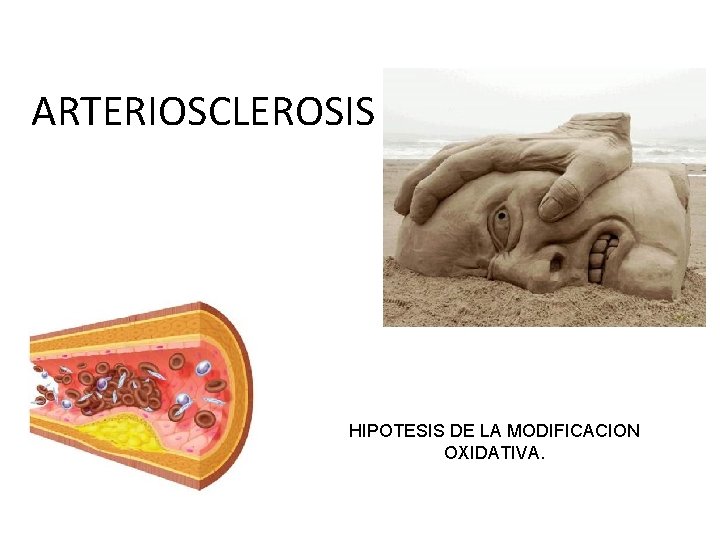 ARTERIOSCLEROSIS HIPOTESIS DE LA MODIFICACION OXIDATIVA. 