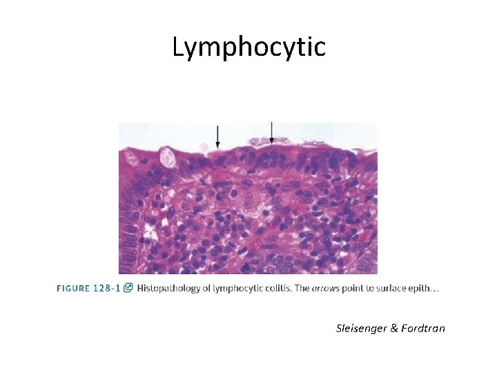 Lymphocytic Sleisenger & Fordtran 
