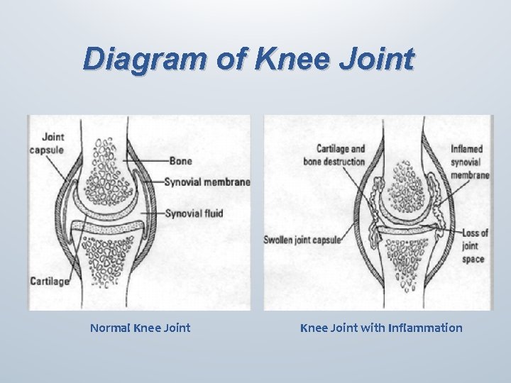 Diagram of Knee Joint Normal Knee Joint with Inflammation 