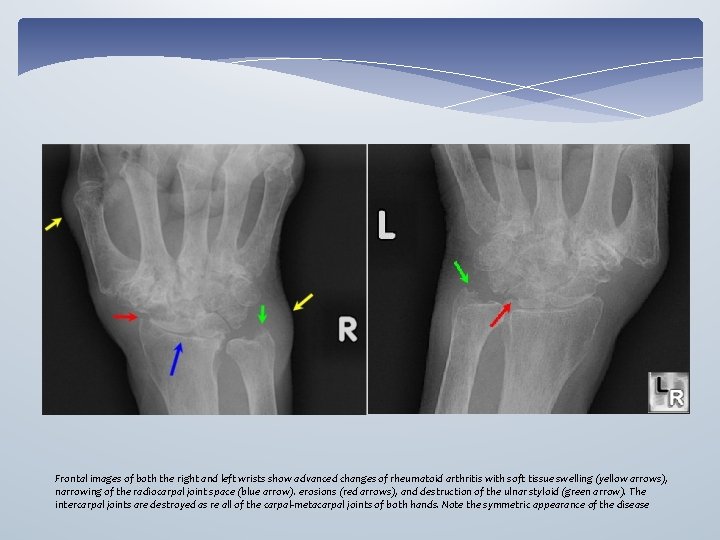 Frontal images of both the right and left wrists show advanced changes of rheumatoid