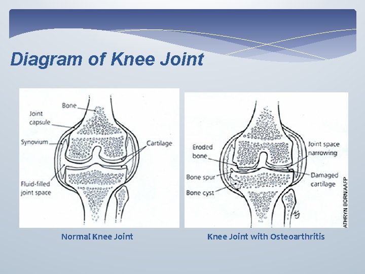 Diagram of Knee Joint Normal Knee Joint with Osteoarthritis 