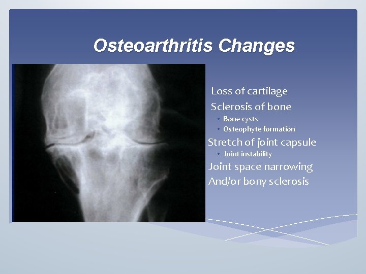 Osteoarthritis Changes • Loss of cartilage • Sclerosis of bone • Bone cysts •