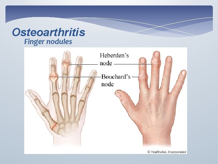 Osteoarthritis Finger nodules 
