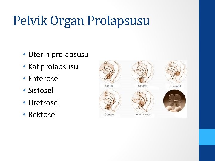 Pelvik Organ Prolapsusu • Uterin prolapsusu • Kaf prolapsusu • Enterosel • Sistosel •