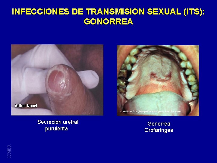 INFECCIONES DE TRANSMISION SEXUAL (ITS): GONORREA ICMER Secreción uretral purulenta Gonorrea Orofaríngea 