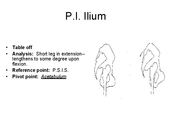 P. I. Ilium • Table off • Analysis: Short leg in extension-lengthens to some