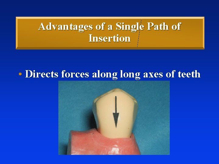 Advantages of a Single Path of Insertion • Directs forces along axes of teeth