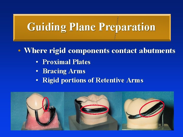 Guiding Plane Preparation • Where rigid components contact abutments • Proximal Plates • Bracing