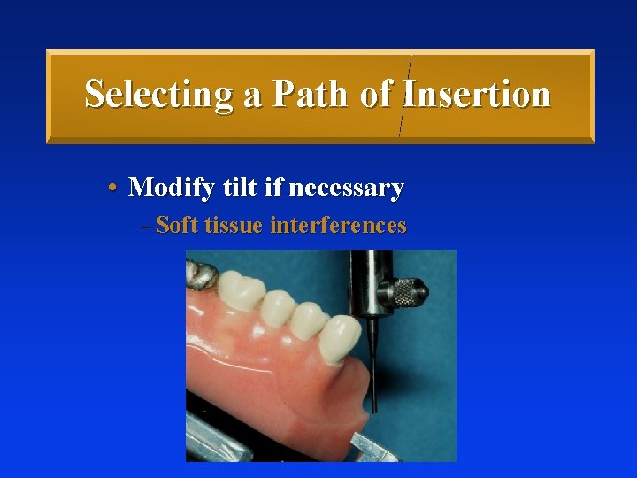 Selecting a Path of Insertion • Modify tilt if necessary – Soft tissue interferences