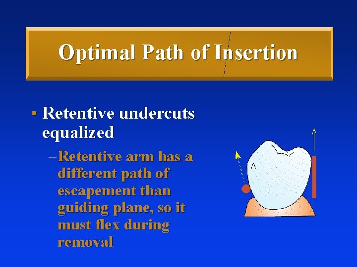 Optimal Path of Insertion • Retentive undercuts equalized – Retentive arm has a different Optimal Path of Insertion • Retentive undercuts equalized – Retentive arm has a different