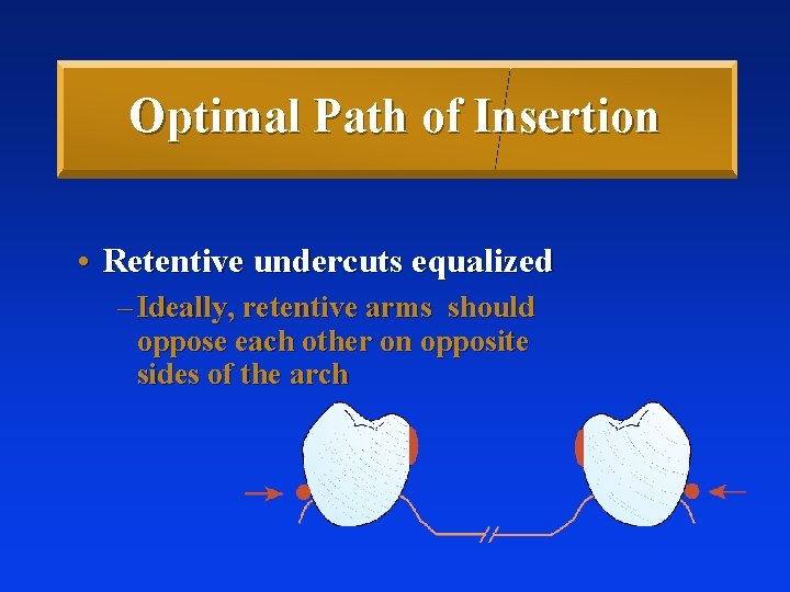 Optimal Path of Insertion • Retentive undercuts equalized – Ideally, retentive arms should oppose