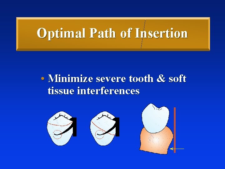 Optimal Path of Insertion • Minimize severe tooth & soft tissue interferences 