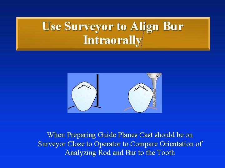 Use Surveyor to Align Bur Intraorally When Preparing Guide Planes Cast should be on