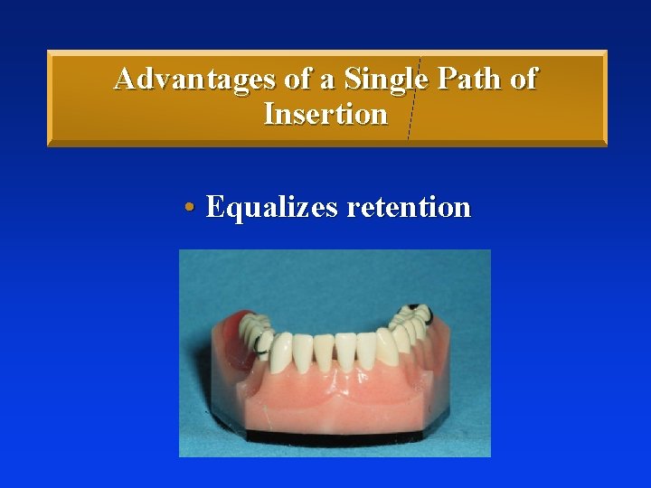 Advantages of a Single Path of Insertion • Equalizes retention 