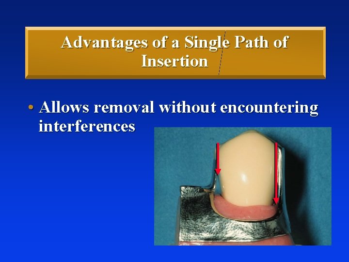 Advantages of a Single Path of Insertion • Allows removal without encountering interferences 