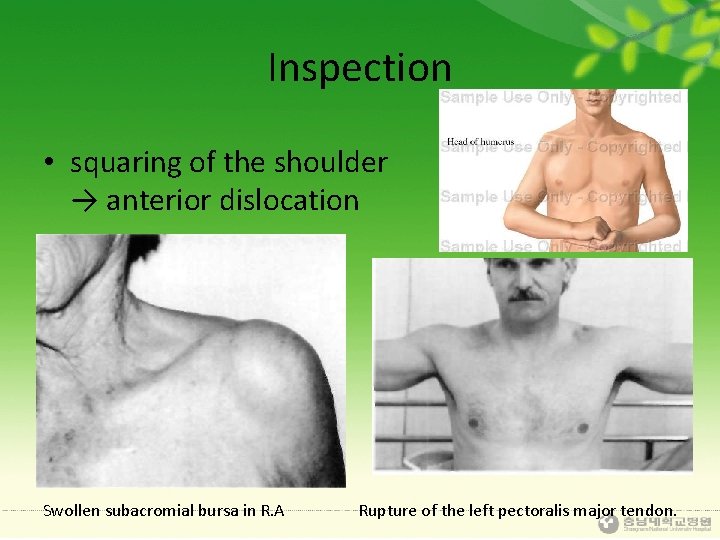 Inspection • squaring of the shoulder → anterior dislocation Swollen subacromial bursa in R.